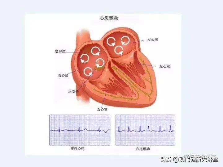 心房颤动的症状,心房颤动的临床特点