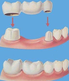 牙齿小知识烤瓷牙,牙医牙齿美白要做吗