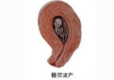 隐匿且沉默的杀手——稽留流产