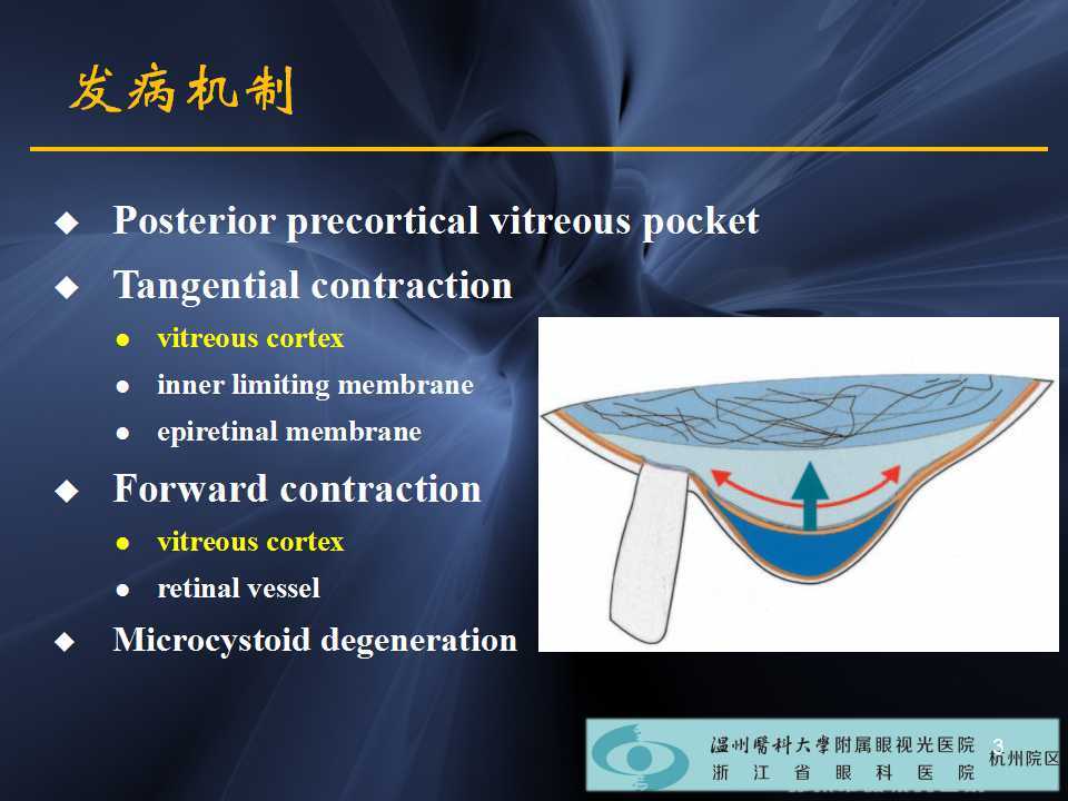 高度近视黄斑劈裂哪家医院好,高度近视黄斑劈裂中医治疗