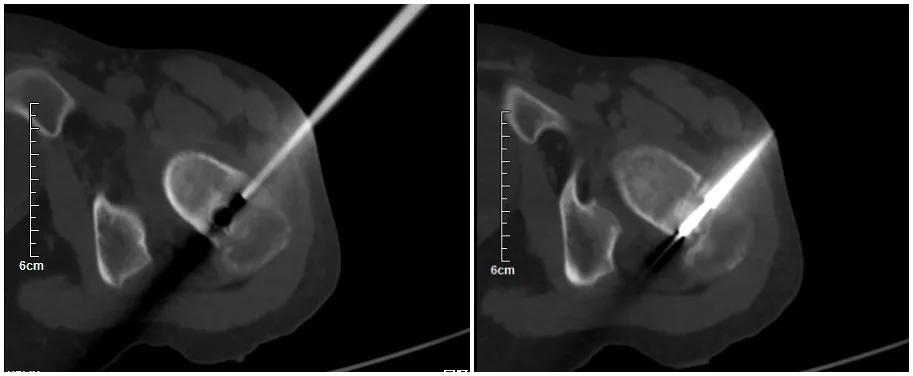 股骨颈肿瘤微创,中医院骨二科