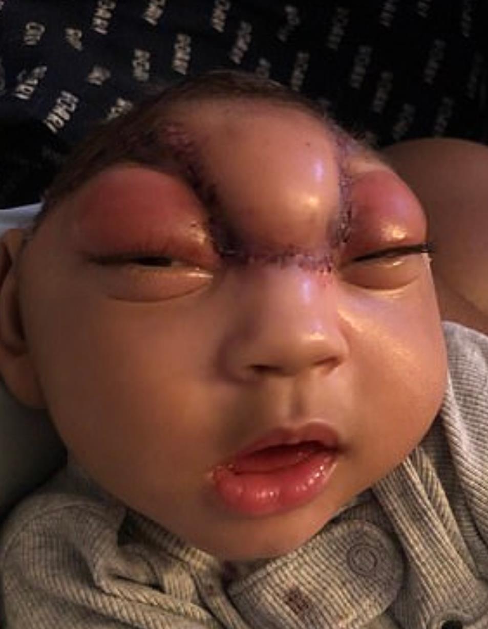 小头畸形的孩子能活多久,孩子出生畸形可以放弃吗