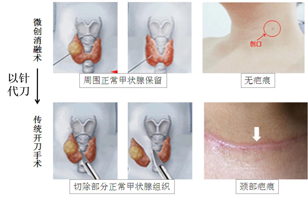 甲状腺结节微创消融手术,甲状腺结节微创消融医保