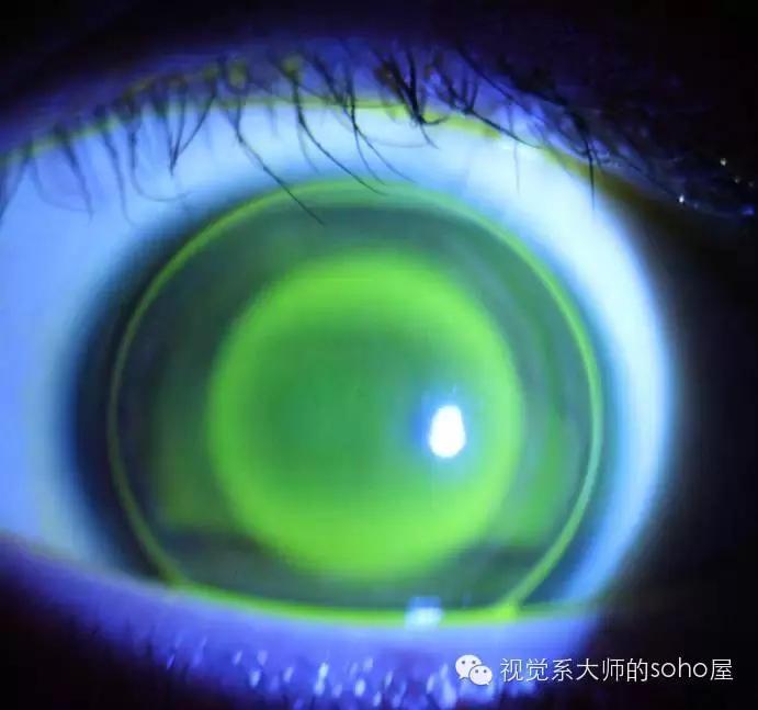 如何选择角膜塑形镜的品牌,怎么选角膜塑形镜的参数