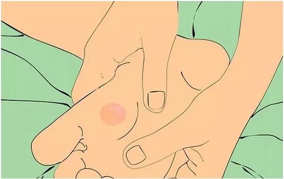 运动起水泡怎么处理好得快,收藏运动