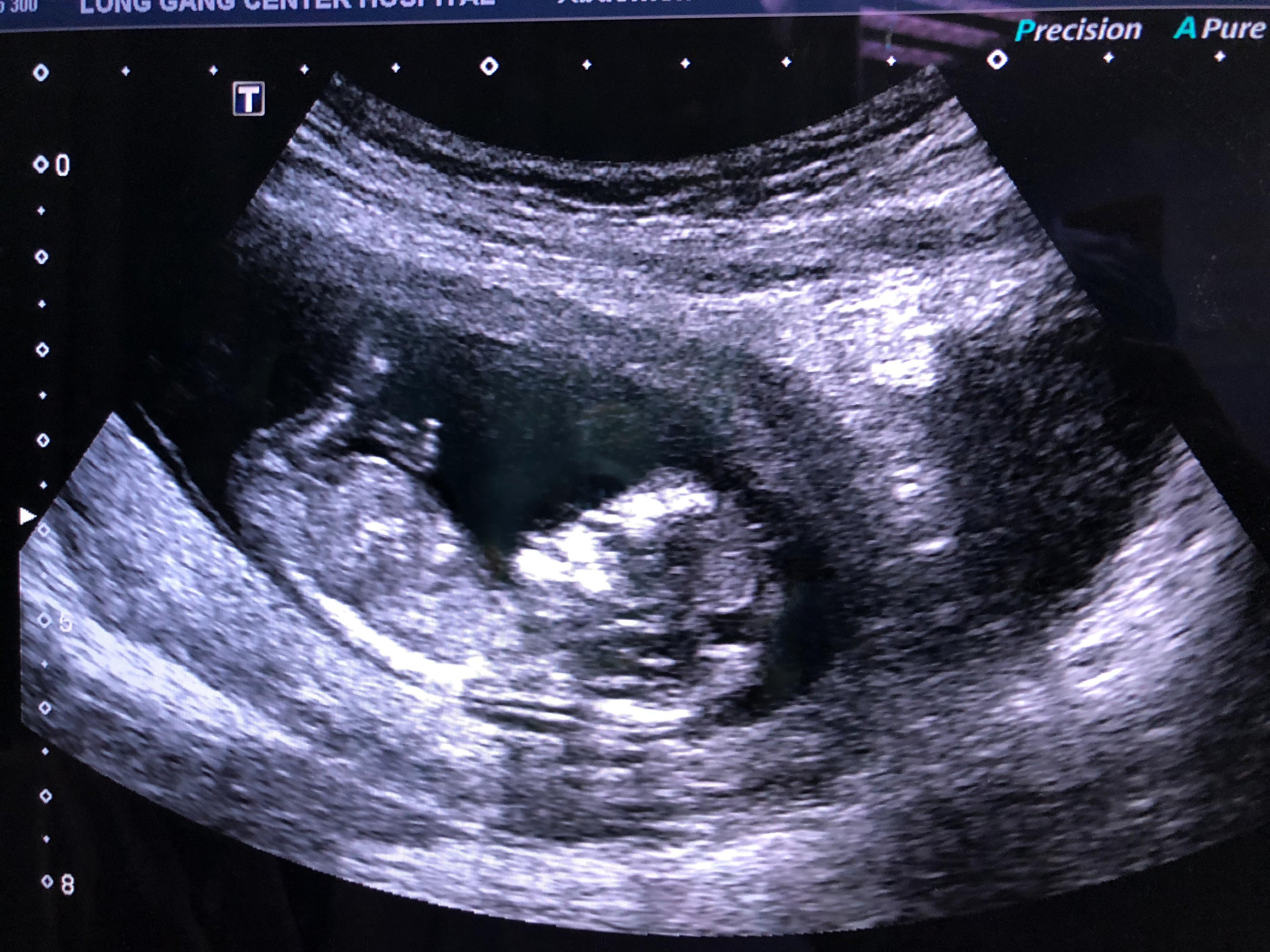 早孕小技巧,小超人测试卷