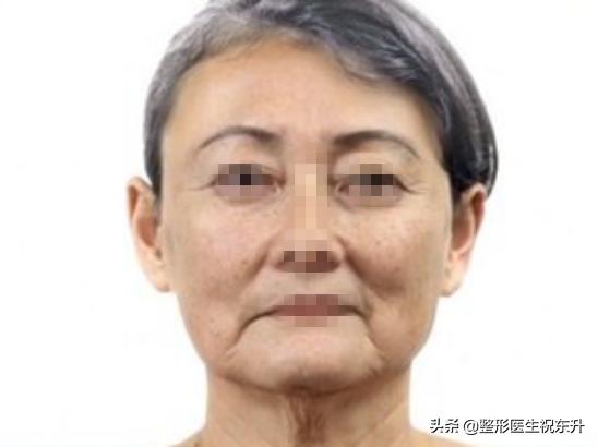 面部除皱手术全过程,面部除皱术的七大类详解