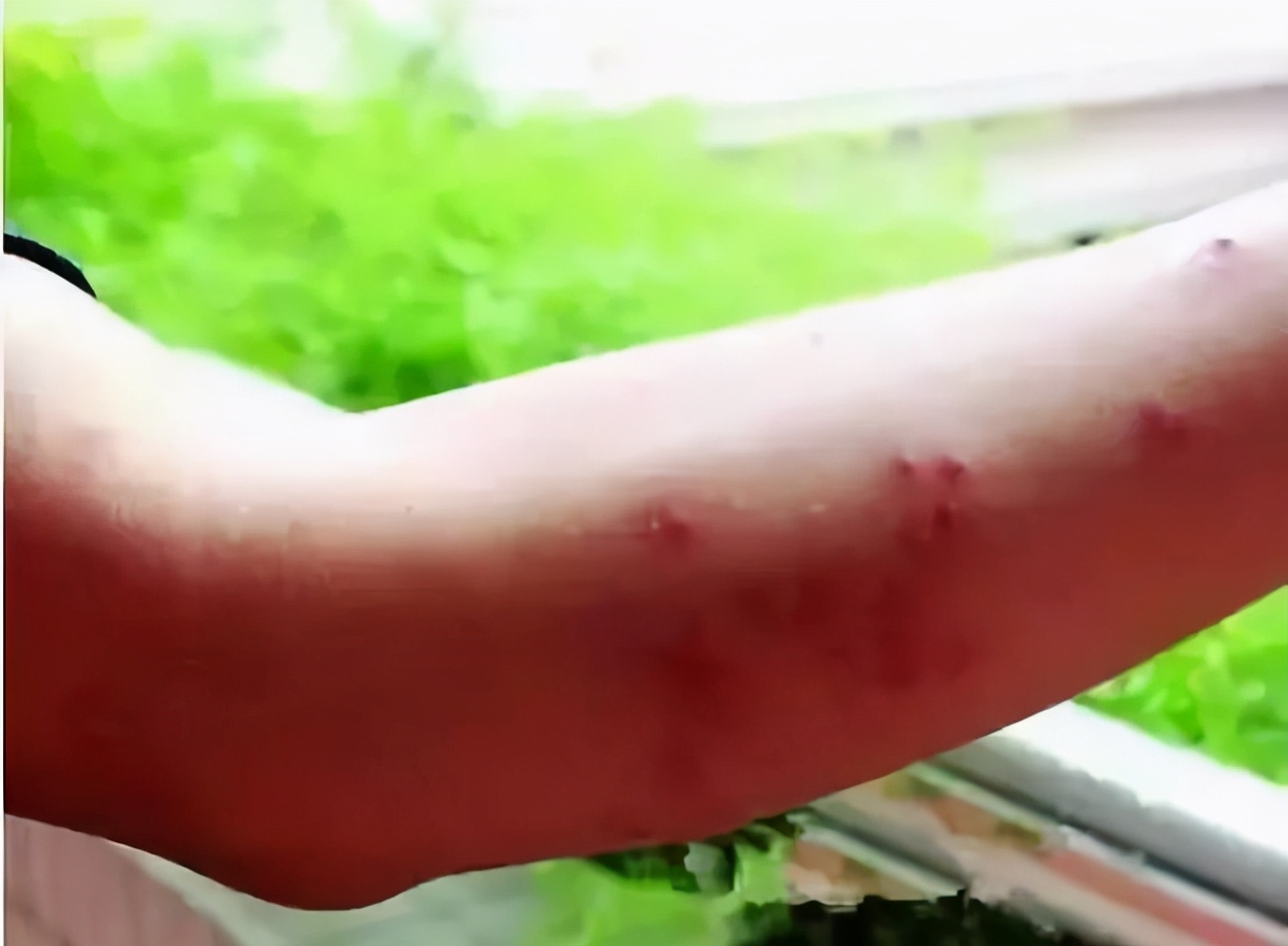 孩子被咬后，若呈现这些状况代表不是蚊子咬的包，别自行处理