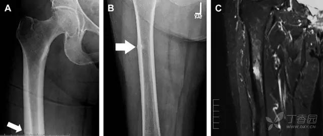 值夜班急救措施,放射科容易漏诊的骨折