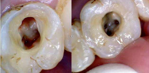 为什么根管治疗后牙齿断裂,根管治疗后的牙怎么做牙冠