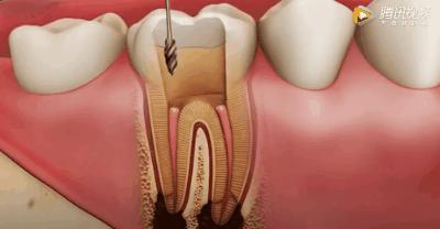 根管治疗可怕,根管治疗很恐怖吗