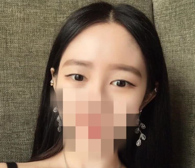 去皮去脂双眼皮恢复大概多长时间,全切双眼皮去皮去脂完全恢复视频