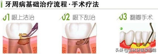 宝宝牙龈红肿出血怎么办,孕期牙龈红肿出血怎么办