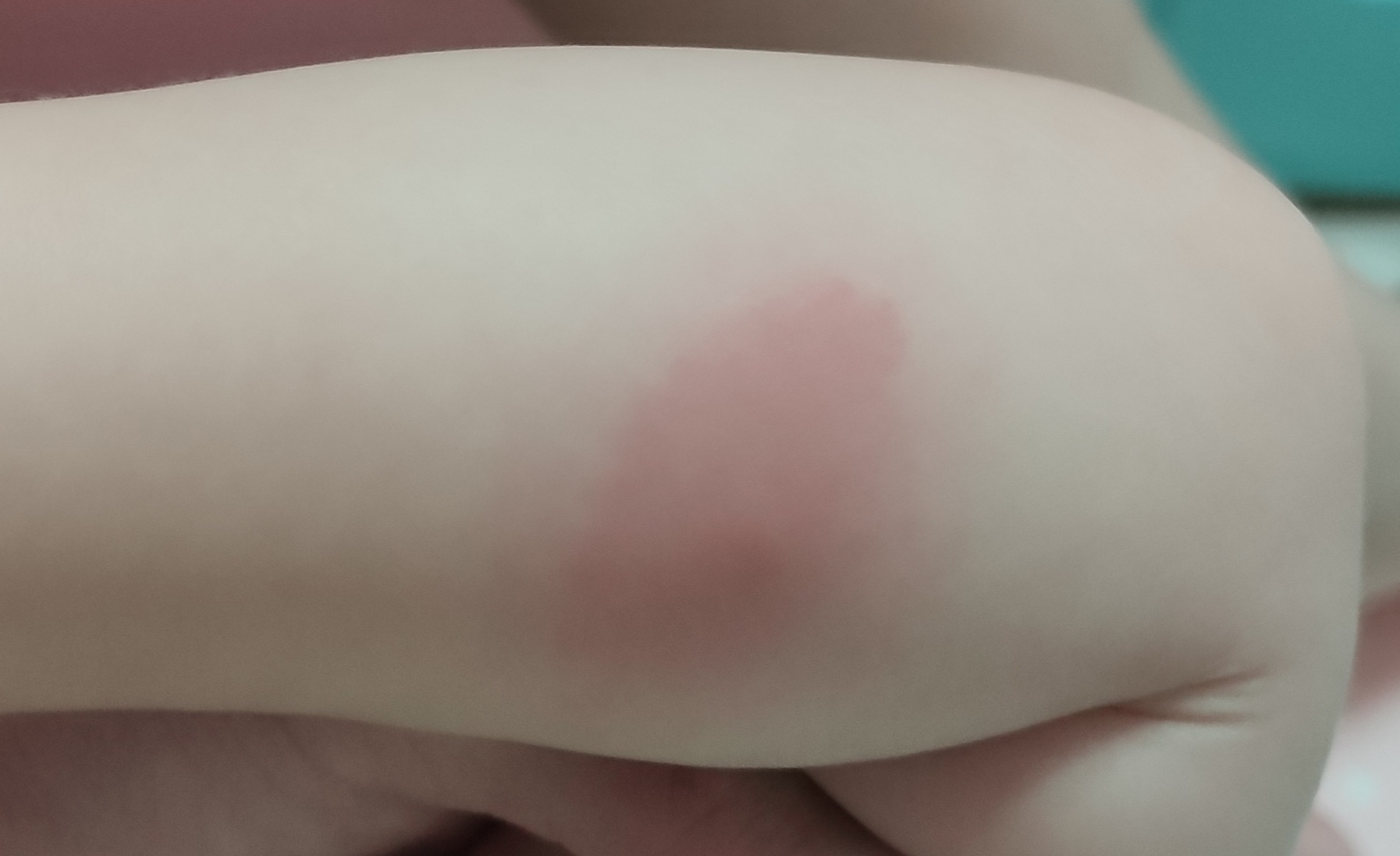 孩子被蚊子咬整个胳膊都肿了,蚊子把婴儿的手咬肿怎么治