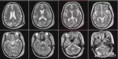 磁共振检查注意事项及禁忌症ppt,磁共振检查注意事项展板