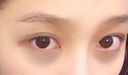 血管型黑眼圈怎么消除,戴眼镜黑眼圈怎么消除