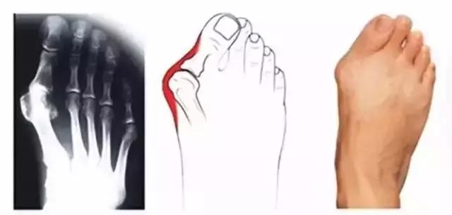 脚拇外翻怎么办教你一招,你的脚好丑的意思