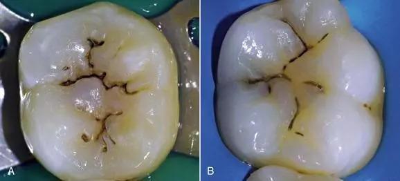 牙齿有黑斑点刷不掉怎么办,牙齿有黑线刷不掉怎么办