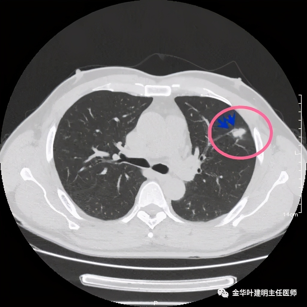 叶建明谈肺结节:一招分辨隐球菌性肉芽肿与肺癌