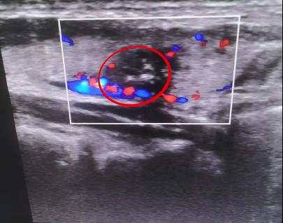 甲状腺结节患者真实案例视频,查出甲状腺结节6年没复查了