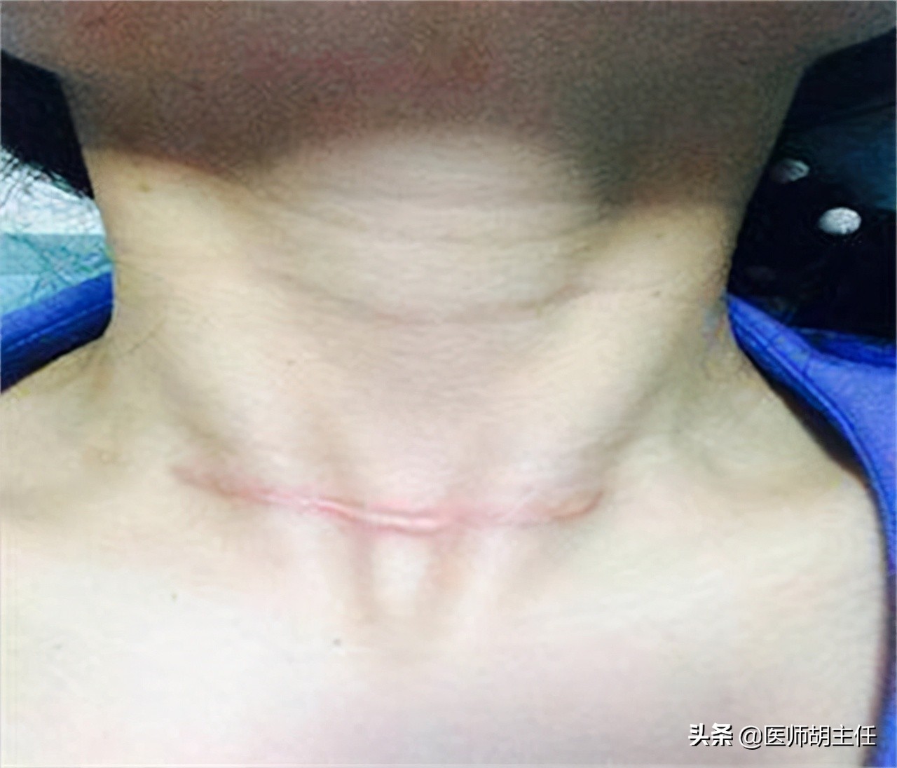 甲状腺全切是把甲状腺切除吗,甲状腺5级需要切除全部甲状腺吗