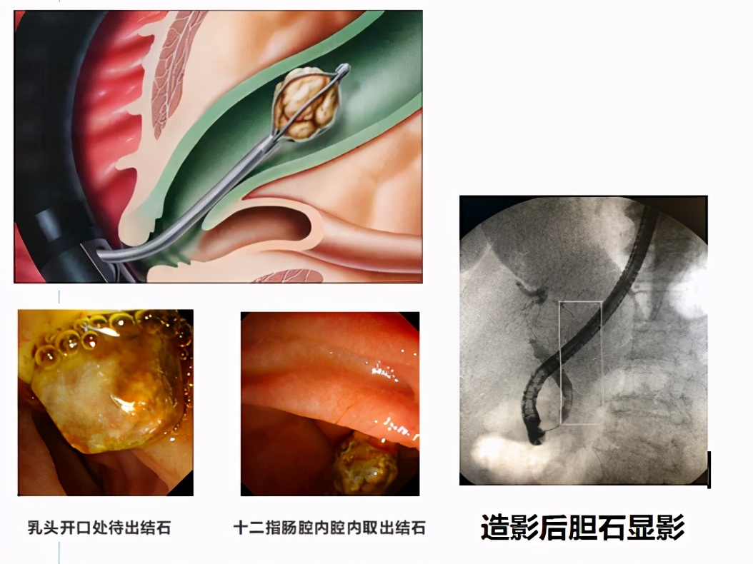肝内胆管结石微创取石需要住院吗,肝内胆管结石腹腔镜取石