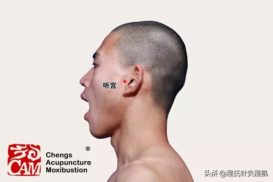 中医治疗耳鸣的效果怎么样,感冒耳鸣怎么快速消除按哪个穴位