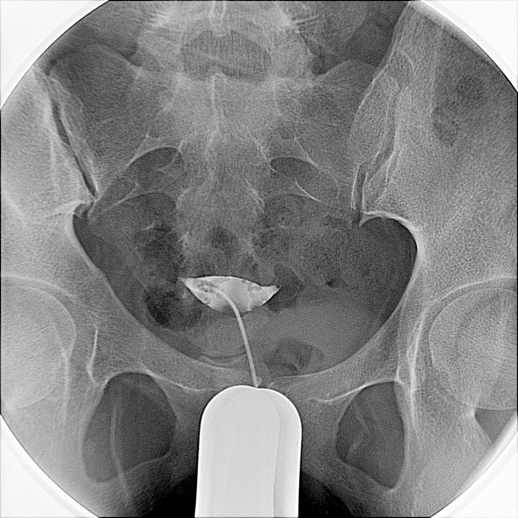 输卵管被堵了，还能怀上孩子吗？能！但要请介入医生“架鹊桥”