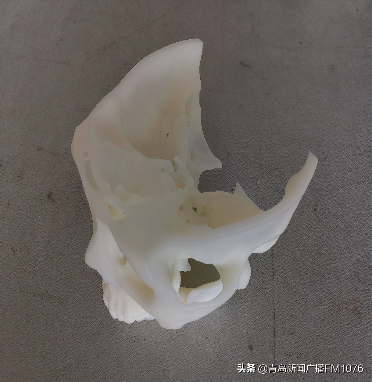 大妈脸不停抽搐,原是耳朵里藏了个大肿瘤,市立专家挑战高难度走位巧摘瘤