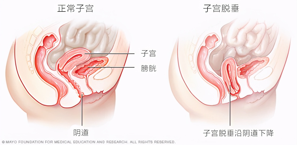 大妈跳广场舞突然掉下“一块肉”，医生竟说是子宫