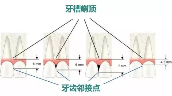 牙龈里的黑东西是什么,牙龈间有黑东西怎么办