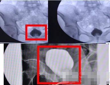 从*醉药麻**到“迷奸药”，*粉K**（氯胺酮）是如何从药物变成*品毒**的？