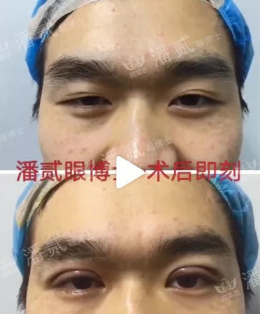 韩式精雕微创双眼皮,韩式微创双眼皮恢复过程真实记录