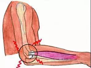 为什么不会打网球还能患上网球肘,不打网球的人会患上网球肘吗