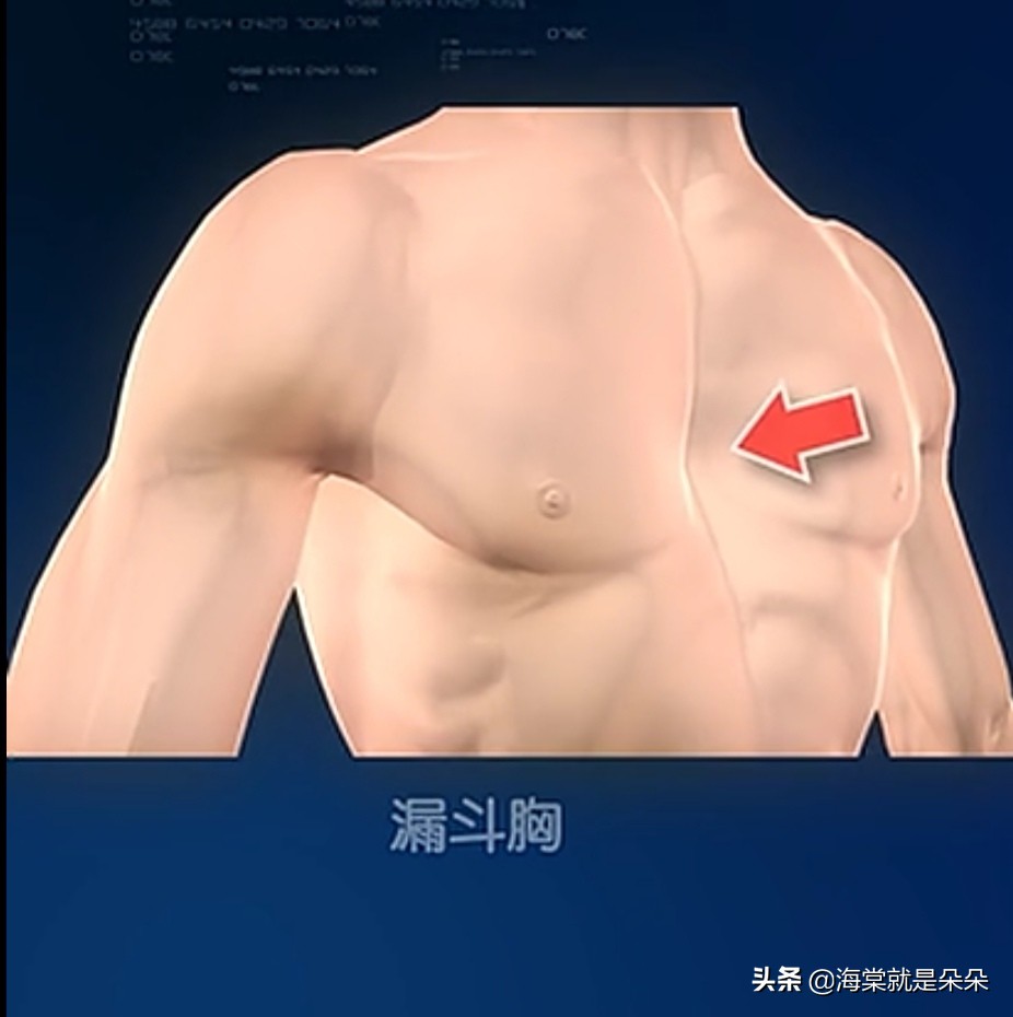 先天漏斗胸跟心脏不好有关吗,成年人漏斗胸压迫心脏