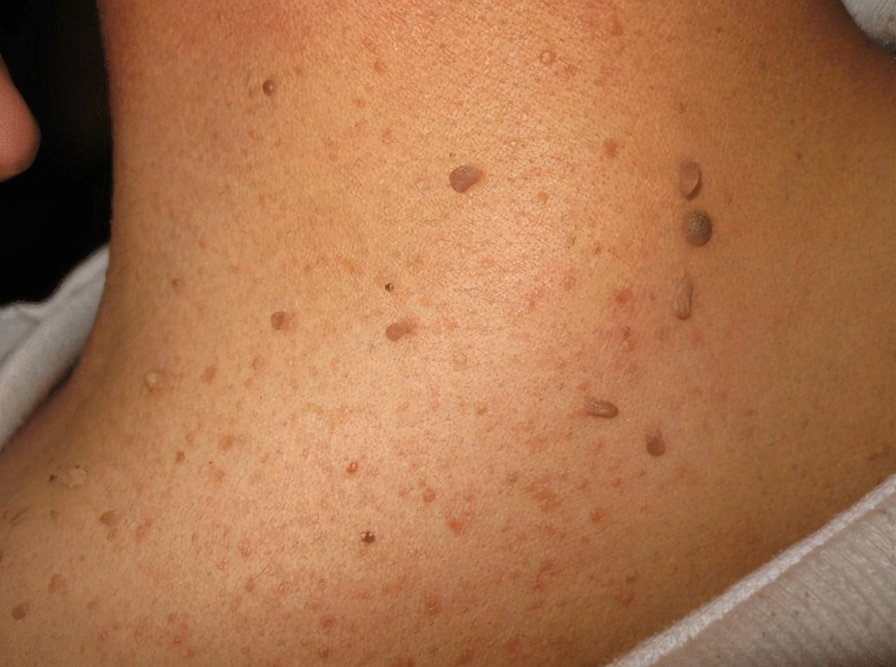 脖子上长的小肉粒揪下来会怎样,脖子和腋下长小肉球是什么原因