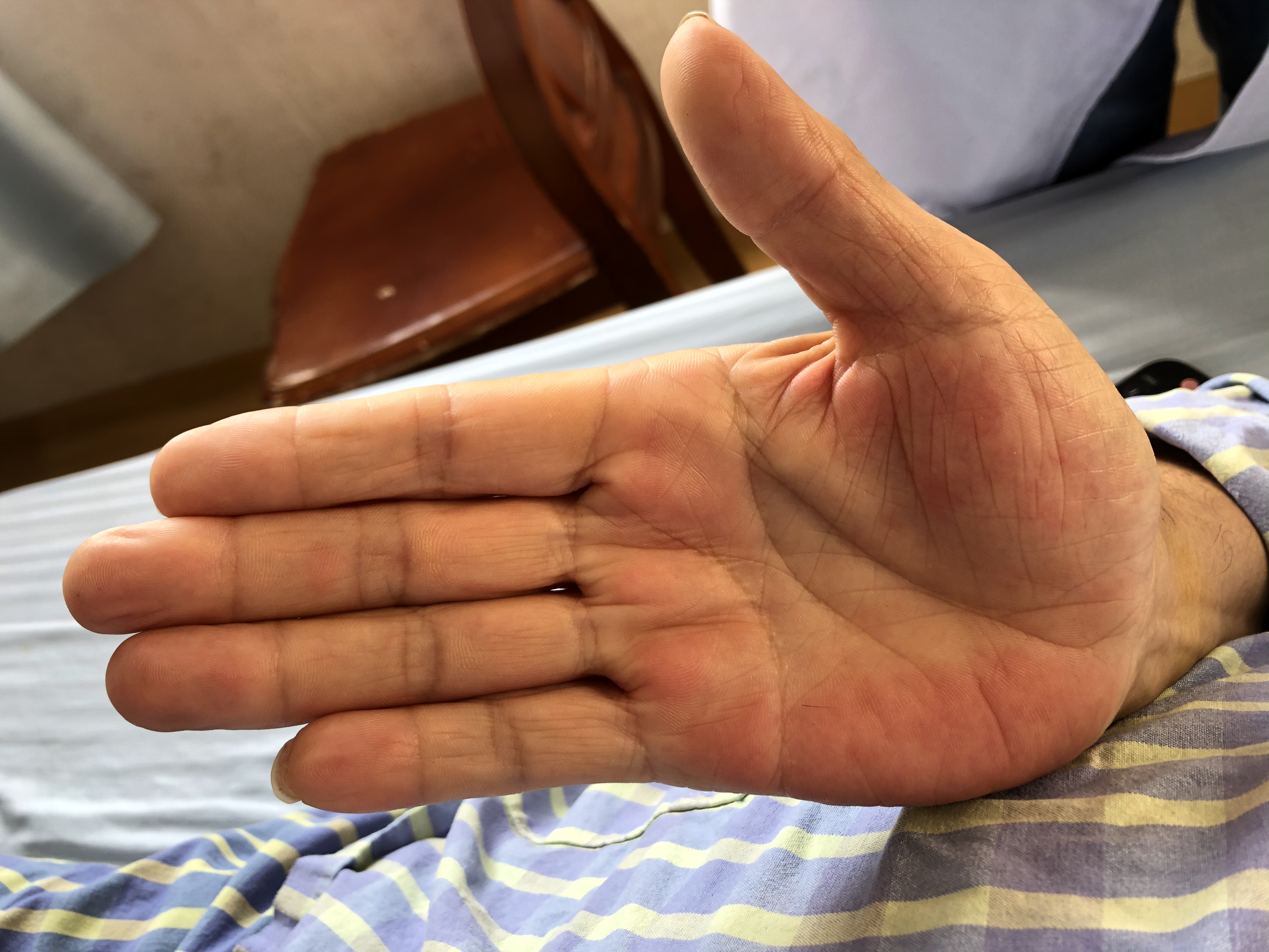 脾大会误诊吗,疑似脾大需要治疗吗