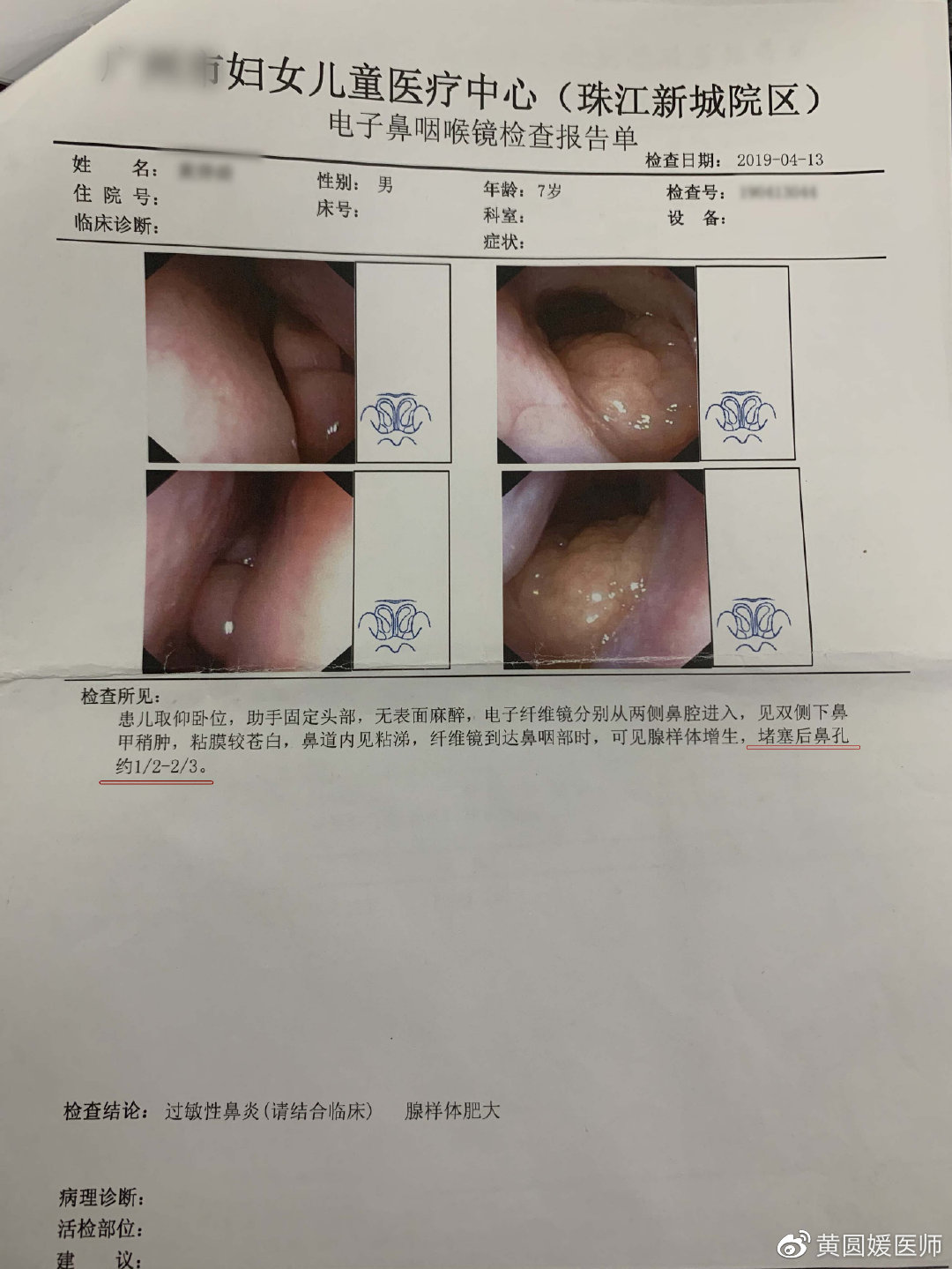打呼张嘴呼吸感冒时最严重,感冒睡觉打呼有大的喘鸣声