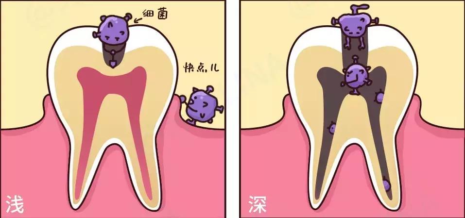 早期补牙,早补好还是晚补好