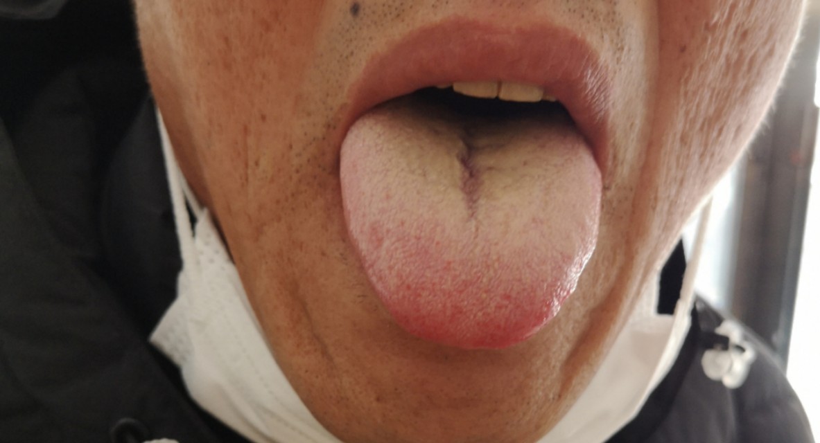 腹部胀满情志焦虑多梦易怒,腹部神经痛焦虑症