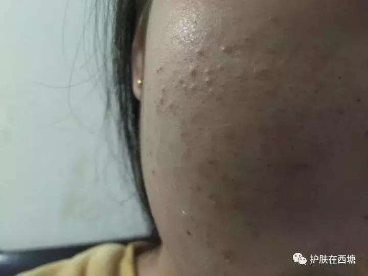 25岁痘痘还是反反复复不好,下巴痘痘反反复复是什么原因
