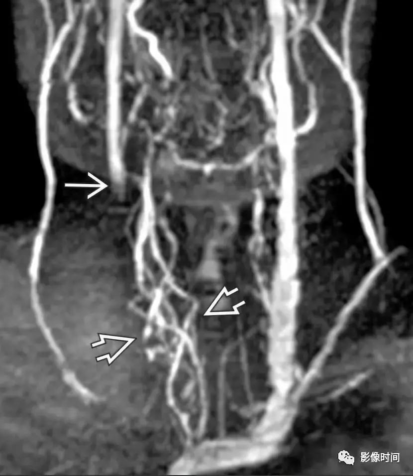 双侧颈动脉鞘间隙多发小淋巴结影,双侧颈动脉间隙多软组织密度结节