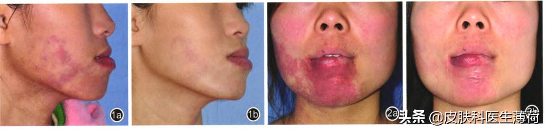 激光点阵祛痘坑收缩毛孔仪器,皮秒激光祛雀斑效果图