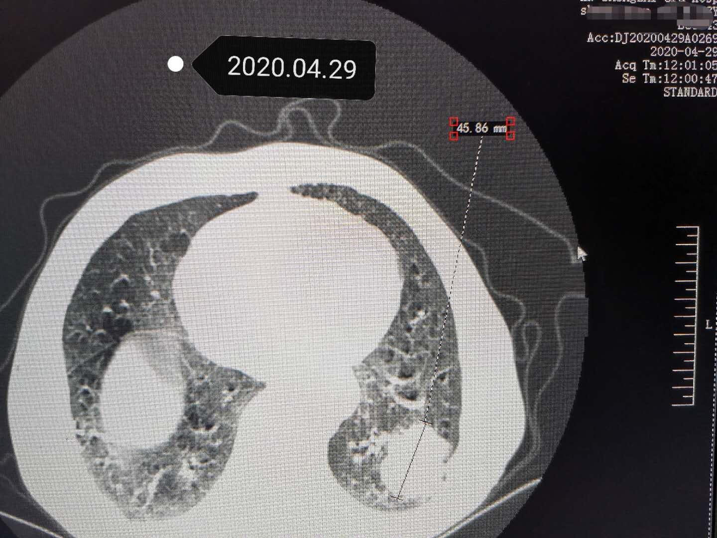 老人肺癌胸疼,外科王医生肺癌