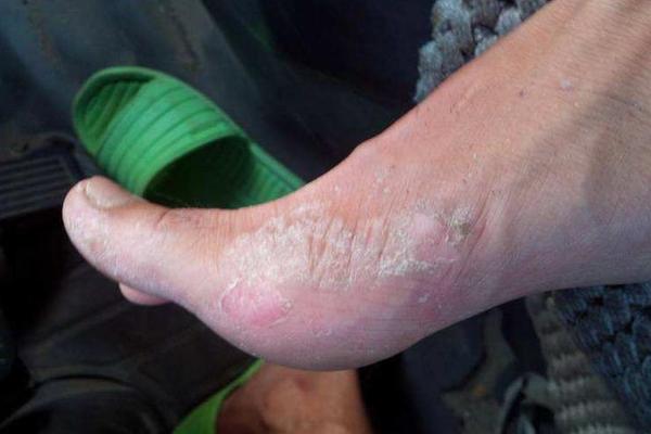 足癣可以泡海水吗,苦参加什么泡脚治足癣