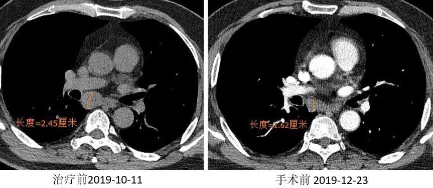 PD-1新辅助治疗初探，典型案例汇总一览
