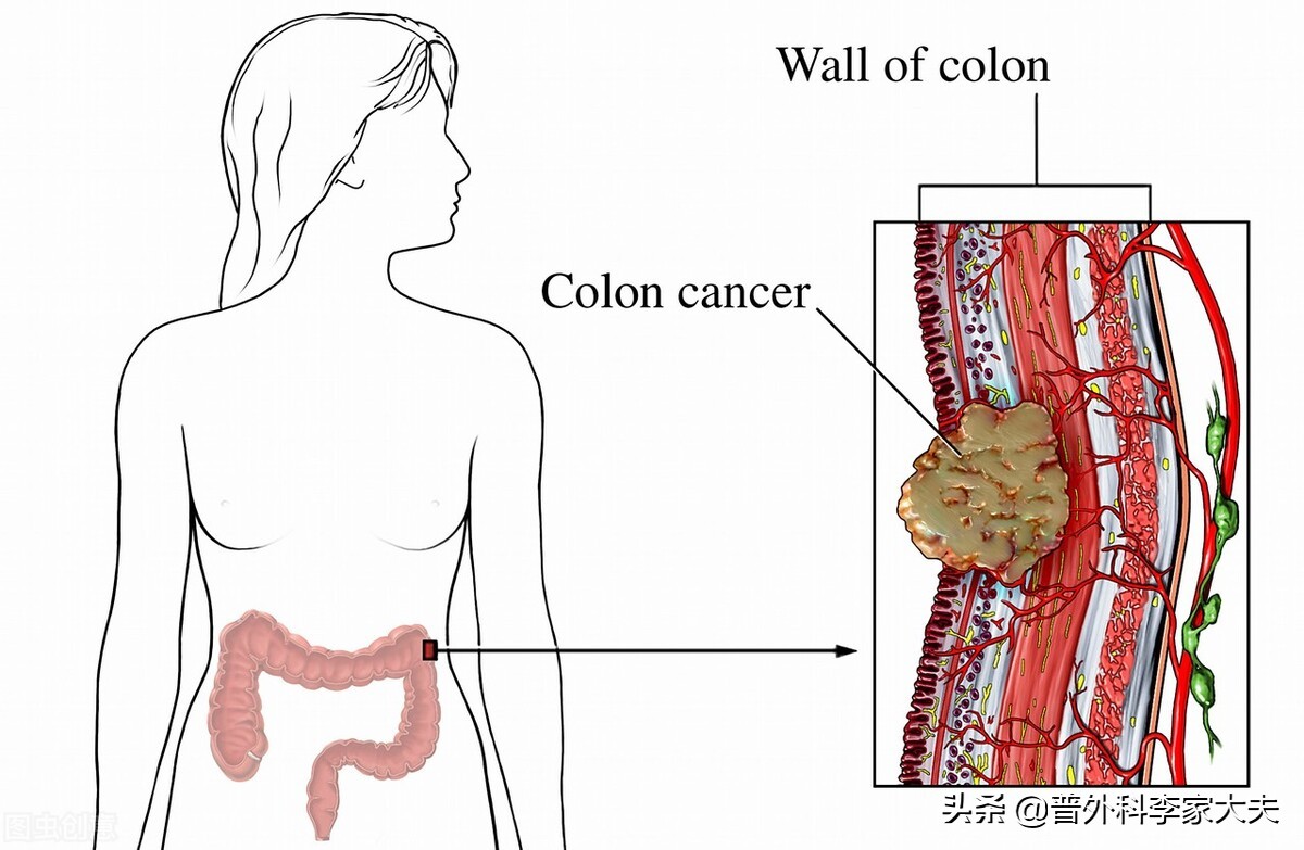 结直肠中，为什么乙状结肠、直肠部分肠癌发病率高？