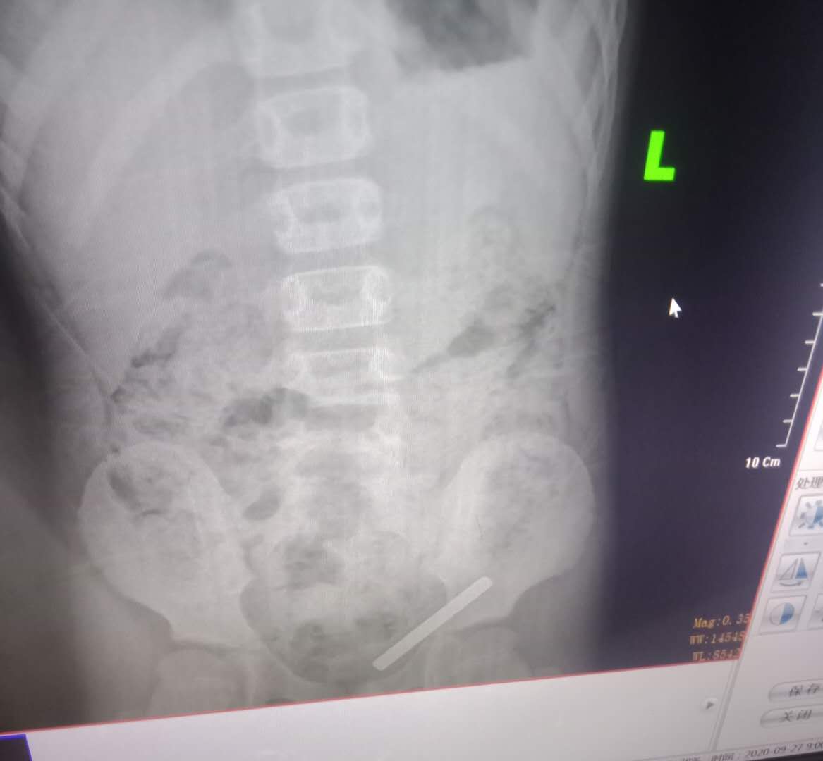 小孩误吞螺丝钉怎么办,二岁小孩误吞螺丝钉几天能拉出来