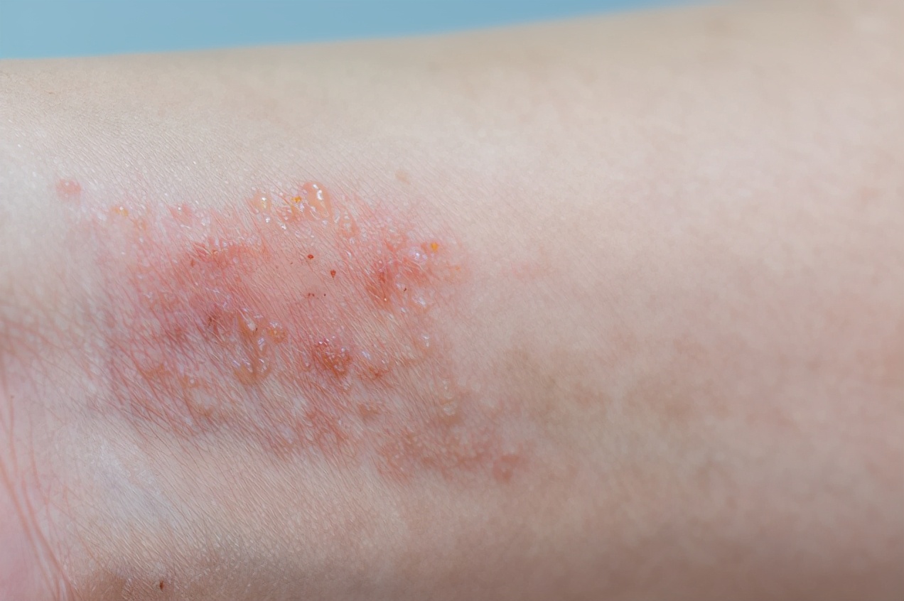 皮肤又红又痒又肿是什么原因,皮肤一抓就红而且凸起还痒怎么办