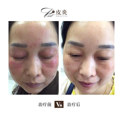 湿疹和皮炎这两种疾病的症状如何区分？湿疹的两种症状你知道吗？